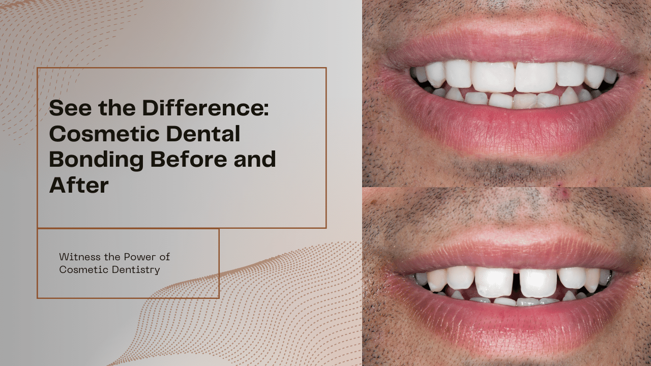 What is cosmetic dental bonding? Check out these key benefits for a better smile