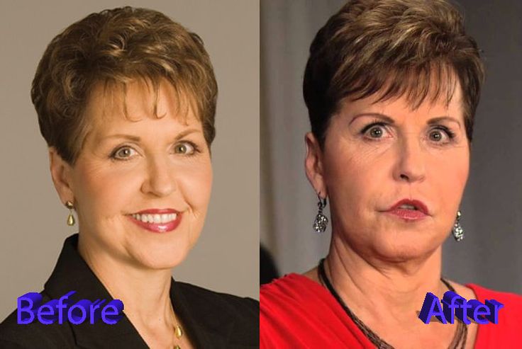 Has Joyce Meyer Had Cosmetic Surgery? See the Before and After Photos!